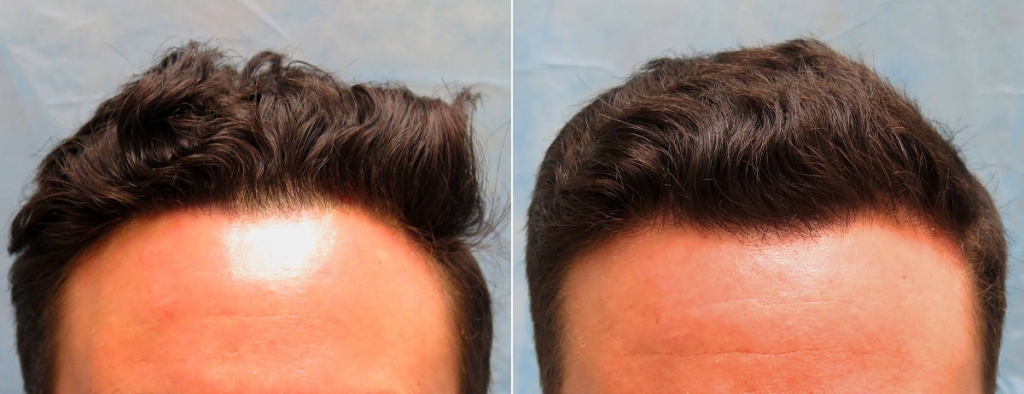 Ārstējiet matu augšanu ar PRP plazmas injekcijām klīnikā Rubenhair